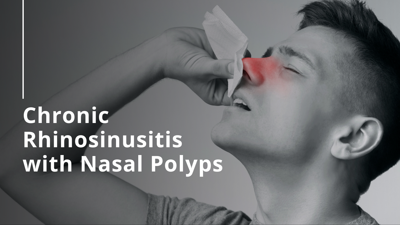 Chronic Rhinosinusitis with Nasal Polyps