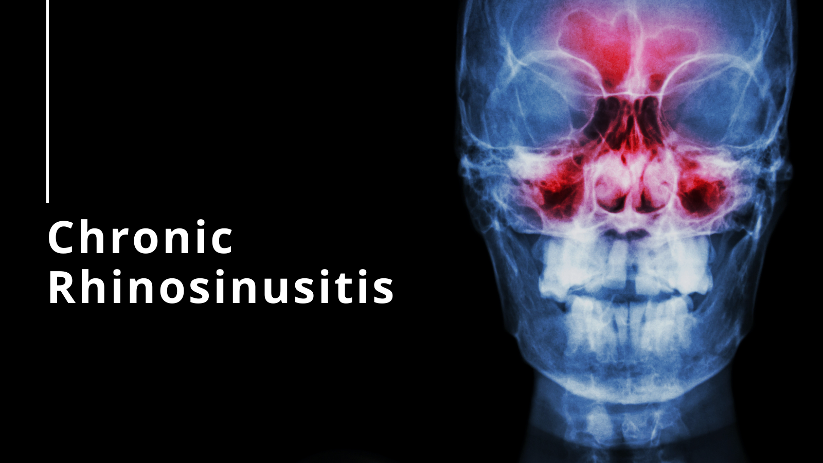 Chronic Rhinosinusitis